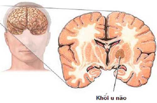 Y sĩ đa khoa liệt kê những nguyên nhân gây u não