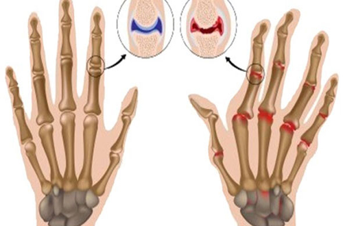 Kỹ thuật viên vật lý trị liệu cho biết vì sao bẻ ngón tay lại phát tiếng kêu răng rắc?