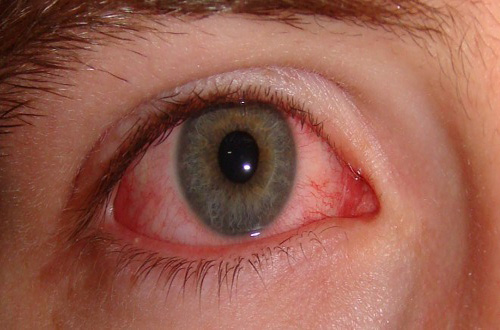 Dược sĩ cho biết cách nhỏ thuốc khi bị đau mắt đỏ?
